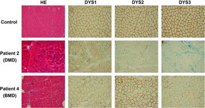 Novel Intronic Mutations Introduce Pseudoexons in DMD That Cause Muscular Dystrophy in Patients